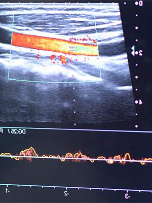 Blood flow Assessment